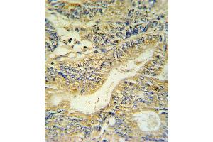 PYY Antibody IHC analysis in formalin fixed and paraffin embedded colon carcinoma followed by peroxidase conjugation of the secondary antibody and DAB staining. (Peptide YY Antikörper  (C-Term))