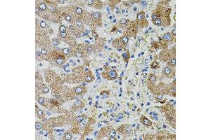 Immunohistochemistry of paraffin-embedded human liver injury using TGFA antibody. (Pro-TGF-alpha Antikörper)