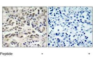 Immunohistochemical analysis of paraffin-embedded human lung carcinoma tissue using CDKN1B polyclonal antibody  . (CDKN1B Antikörper  (Ser10))
