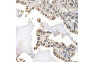 Immunohistochemistry of paraffin-embedded human thyroid cancer using GTF2F1 antibody (ABIN5971324) at dilution of 1/200 (40x lens). (GTF2F1 Antikörper)
