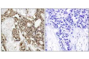 Immunohistochemical analysis of paraffin-embedded human breast carcinoma tissue, using p44/42 MAP Kinase (phospho-Tyr204) antibody (E011246). (ERK1/2 Antikörper  (pTyr204))
