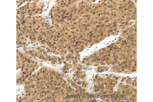 Immunohistochemistry of Human liver cancer using TERF2 Polyclonal Antibody at dilution of 1:30 (TRF2 Antikörper)