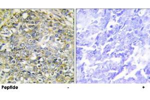 Immunohistochemistry analysis of paraffin-embedded human lung carcinoma tissue using UBXN11 polyclonal antibody . (UBXN11 Antikörper)