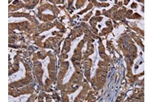 The image on the left is immunohistochemistry of paraffin-embedded Human esophagus cancer tissue using ABIN7130206(MCTS1 Antibody) at dilution 1/30, on the right is treated with fusion protein. (MCTS1 Antikörper)