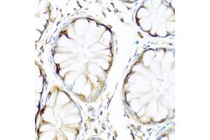 Immunohistochemistry of paraffin-embedded human colon using APCS antibody (ABIN5971040) at dilution of 1/100 (40x lens). (APCS Antikörper)