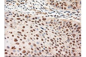 Immunohistochemical staining of paraffin-embedded Adenocarcinoma of breast using anti-NTF4 (ABIN2452547) mouse monoclonal antibody. (Neurotrophin 4 Antikörper  (AA 81-210))