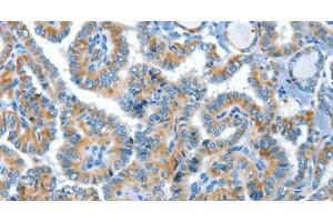 Immunohistochemistry of paraffin-embedded Human thyroid cancer tissue using COG1 Polyclonal Antibody at dilution 1:60 (COG1 Antikörper)