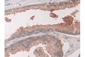 Detection of USP6NL in Human Prostate Tissue using Polyclonal Antibody to USP6 N-Terminal Like Protein (USP6NL)