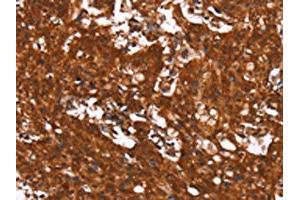 The image on the left is immunohistochemistry of paraffin-embedded Human gastic cancer tissue using ABIN7190910(HCAR2 Antibody) at dilution 1/40, on the right is treated with synthetic peptide. (HCAR2 Antikörper)