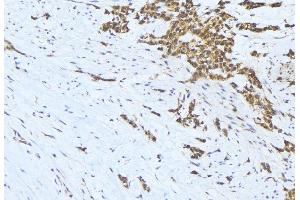 ABIN6275653 at 1/100 staining Human lung cancer tissue by IHC-P. (USP19 Antikörper  (Internal Region))