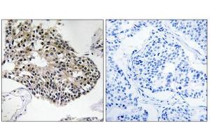 Immunohistochemistry analysis of paraffin-embedded human breast carcinoma tissue using RPS25 antibody. (RPS25 Antikörper  (C-Term))