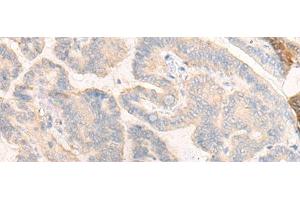Immunohistochemistry of paraffin-embedded Human thyroid cancer tissue using COG4 Polyclonal Antibody at dilution of 1:30(x200) (COG4 Antikörper)