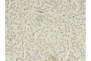 Immunohistochemistry of paraffin-embedded human breast cancer using ABIN7151851 at dilution of 1:100 (EPH Receptor A7 Antikörper  (AA 28-182))