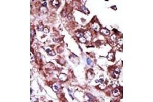 Formalin-fixed and paraffin-embedded human cancer tissue reacted with the primary antibody, which was peroxidase-conjugated to the secondary antibody, followed by AEC staining. (NME7 Antikörper  (N-Term))