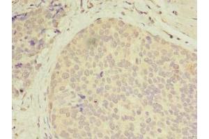 Immunohistochemistry of paraffin-embedded human gastric cancer using ABIN7146141 at dilution of 1:100 (CXCL6 Antikörper  (AA 38-114))