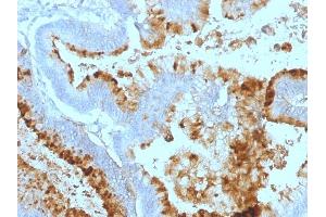 Formalin-fixed, paraffin-embedded human Colon Carcinoma stained with Lewis A Monoclonal Antibody (7LE). (Blood Group Lewis A Antikörper)