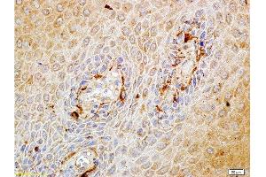 Formalin-fixed and paraffin embedded human endometrium carcinoma labeled with Rabbit Anti-Matriptase Polyclonal Antibody, Unconjugated at 1:100 followed by conjugation to the secondary antibody and DAB staining.