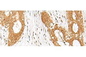 Immunohistochemistry of paraffin-embedded Human breast cancer tissue using IPO11 Polyclonal Antibody at dilution of 1:70(x200) (Importin 11 Antikörper)