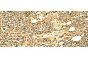 Immunohistochemistry of paraffin-embedded Human ovarian cancer using ECE2 Polyclonal Antibody at dilution of 1/25 (ECE2 Antikörper)