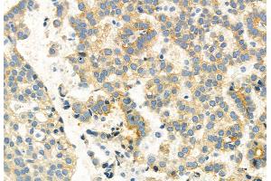 ABIN6261462 and ABIN6269075 at 1/100 staining Human lung cancer by IHC-P.