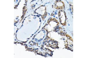 Immunohistochemistry of paraffin-embedded human thyroid cancer using RBBP9 Rabbit pAb (ABIN6129095, ABIN6146752, ABIN6146753 and ABIN6220638) at dilution of 1:200 (40x lens). (RBBP9 Antikörper  (AA 1-186))