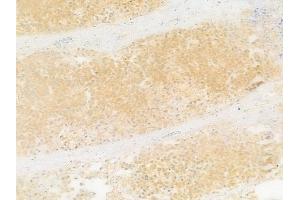 ABIN7093228 and ABIN7097240 at 1/100 staining human prostate carcinoma by IHC-P. (Insulin Receptor Antikörper  (pTyr1355))