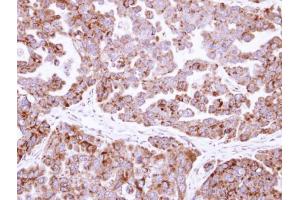 IHC-P Image Immunohistochemical analysis of paraffin-embedded OVCAR3 xenograft, using fumarate hydratase , antibody at 1:500 dilution. (FH Antikörper)