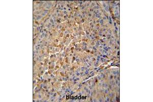 MAPRE1 antibody immunohistochemistry analysis in formalin fixed and paraffin embedded human bladder carcinoma followed by peroxidase conjugation of the secondary antibody and DAB staining.