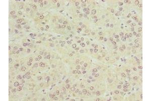 Immunohistochemistry of paraffin-embedded human liver cancer using ABIN7147940 at dilution of 1:100 (CIPC/KIAA1737 Antikörper  (AA 1-399))
