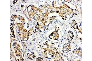 IHC-P: SERCA2 ATPase antibody testing of human breast cancer tissue (SERCA2 ATPase (Middle Region) Antikörper)