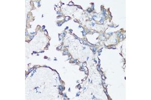Immunohistochemistry of paraffin-embedded human lung cancer using Src antibody (ABIN6132240, ABIN6148428, ABIN6148429 and ABIN6215399) at dilution of 1:100 (40x lens). (Src Antikörper  (AA 1-80))