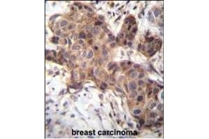 GDF9 Antibody (N-term) (ABIN656116 and ABIN2845455) immunohistochemistry analysis in formalin fixed and paraffin embedded human breast carcinoma followed by peroxidase conjugation of the secondary antibody and DAB staining.