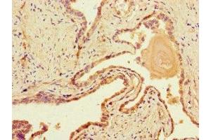Immunohistochemistry of paraffin-embedded human prostate cancer using ABIN7150861 at dilution of 1:100 (DNAH1 Antikörper  (AA 2225-2407))