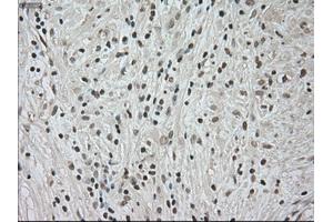 Immunohistochemical staining of paraffin-embedded Carcinoma of kidney tissue using anti-NTRK3mouse monoclonal antibody. (NTRK3 Antikörper)