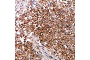 Immunohistochemical analysis of Vimentin staining in human breast cancer formalin fixed paraffin embedded tissue section. (Vimentin Antikörper  (C-Term))