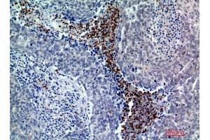 Immunohistochemistry (IHC) analysis of paraffin-embedded Human Breast Cancer, antibody was diluted at 1:200. (BATF3 Antikörper)