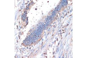 Immunohistochemistry of paraffin-embedded human colon carcinoma using CD44 antibody (ABIN3021912, ABIN3021913, ABIN3021914 and ABIN6217536) at dilution of 1:200 (40x lens). (CD44 Antikörper  (AA 35-300))