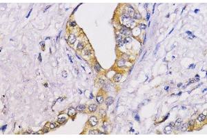 Immunohistochemistry of paraffin-embedded Human lung cancer using Bcl-2 Polyclonal Antibody at dilution of 1:100 (40x lens). (Bcl-2 Antikörper)