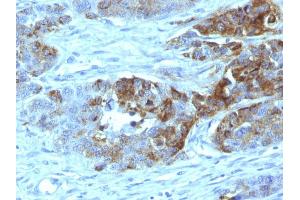 Formalin-fixed, paraffin-embedded human Colon Carcinoma stained with Blood Group Antigen H Type 2 Monoclonal Antibody (19-OLE) (ABO Antikörper)