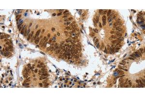 Immunohistochemistry of paraffin-embedded Human colon cancer using COPS5 Polyclonal Antibody at dilution of 1:120 (COPS5 Antikörper)