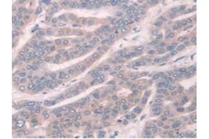 IHC-P analysis of Human Liver Cancer Tissue, with DAB staining. (TPMT Antikörper  (AA 26-227))