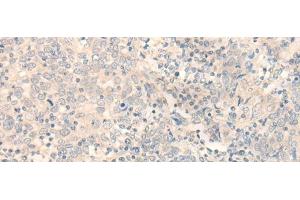 Immunohistochemistry of paraffin-embedded Human cervical cancer tissue using ERP27 Polyclonal Antibody at dilution of 1:35(x200) (ERP27 Antikörper)