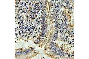 Immunohistochemical analysis of DPP3 staining in human colon cancer formalin fixed paraffin embedded tissue section. (DPP3 Antikörper)