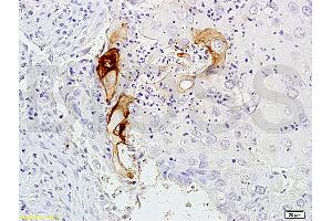 Immunohistochemistry (IHC) image for anti-Carcinoembryonic Antigen Gene Family (CEA) antibody (ABIN722931) (CEA Antikörper)