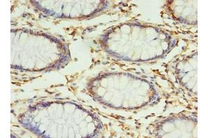Immunohistochemistry of paraffin-embedded human colon cancer using ABIN7159947 at dilution of 1:100 (RPUSD4 Antikörper  (AA 41-240))