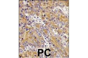 Formalin-fixed and paraffin-embedded human prostata carcinoma tissue reacted with MYO1C antibody (C-term), which was peroxidase-conjugated to the secondary antibody, followed by DAB staining. (Myosin ID Antikörper  (C-Term))