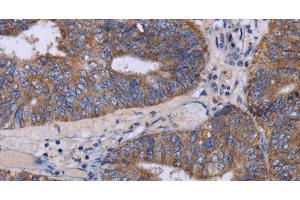 Immunohistochemistry of paraffin-embedded Human colon cancer tissue using MT3 Polyclonal Antibody at dilution 1:50 (MT3 Antikörper)