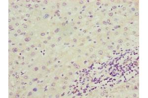 Immunohistochemistry of paraffin-embedded human liver cancer using ABIN7143865 at dilution of 1:100 (ENO1 Antikörper  (AA 2-428))