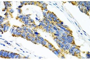 Immunohistochemistry of paraffin-embedded Human colon carcinoma using CYP1A1 Polyclonal Antibody at dilution of 1:100 (40x lens). (CYP1A1 Antikörper)