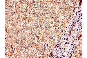 Immunohistochemistry of paraffin-embedded human liver cancer using ABIN7148300 at dilution of 1:100 (COMMD1 Antikörper  (AA 2-190))